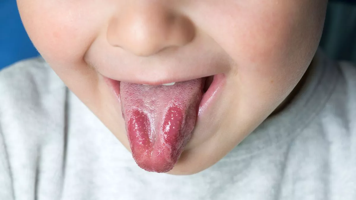 Geographic Tongue Penyebab, Gejala, Pengobatan KlikDokter